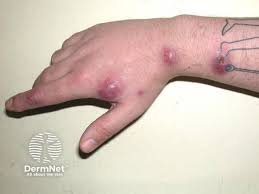 Image result for Skin Infection