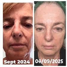 What's the difference between frankincense and bakuchiol in skincare?