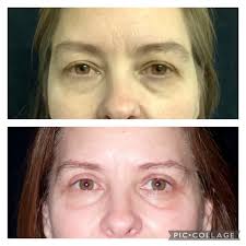 Eyelid Lift Albuquerque NM, D. Eric Tuggle, D.D.S.