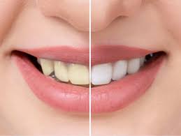 The best home teeth whitening methods may be as easy as changing a few habits. How To Whiten Your Teeth With Common Kitchen Ingredients The Times Of India