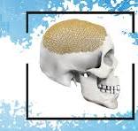 Cranial Titanium Mesh | Cranial Cut