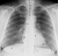 Anatomy of chest x ray. Week 2 Chest X Ray Flashcards Quizlet