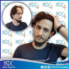 Murat Ozer Seyrelen Saclarini Geri Kazanmak Icin Hdc Yi Tercih Etti Hdc Sac Sacdokulmesi Sackaybi Hayatdegisimmerkezi Pro Sac Sac Dokulmesi Sac Bakimi