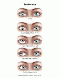 Image result for Strabismus