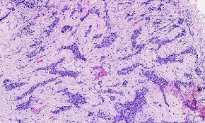 Because it is rare, desmoplastic mesothelioma is not well understood; Pathology Outlines Mesothelioma Pleura Epithelioid