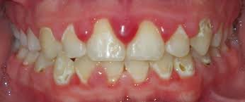 Many toddlers swallow the toothpaste while brushing. Why Do Braces Cause White Spots On My Teeth Orthodontist In Atlanta