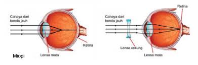 Lensa tersebut merupakan lensa cekung atau lensa negatif yang memiliki sifat divergen. Cacat Mata Mutiaraadiesta