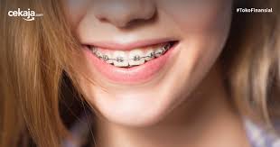 Karet behel lepas pasang sendiri memiliki beberapa model seperti model power o / sering disebut bulat / kotak ( ini karena saat dipasang di braket bentuk nya menjadi kotak ) , mickey. Jenis Jenis Behel Yang Sering Dipakai Beserta Biaya Pemasangannya