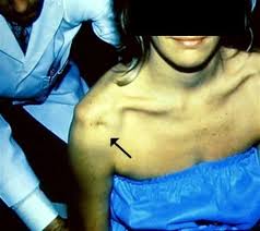 Image result for PCL Sulcus Test