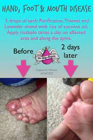 These viruses are found in the nose and throat secretions (such as saliva, sputum, or mucus from the nose), fluid in blisters, and stool of. Natural Remedy For Hand Foot And Mouth Disease Just In Case This Is Going Around Essential Oils For Kids Essential Oils For Babies Living Essentials Oils