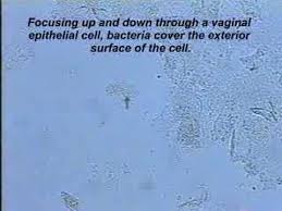 The slide is looked at under a microscope for bacteria, yeast cells, trichomoniasis (trichomonads), white blood cells that show an infection, or clue cells that show bacterial vaginosis. Bacterial Vaginosis Clue Cells Youtube