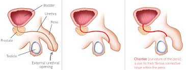 Image result for Chordee