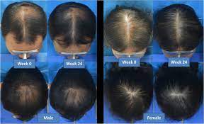 These photons are absorbed by weak cells to encourage hair growth. Low Level Laser Therapy For The Treatment Of Androgenetic Alopecia In Thai Men And Women A 24 Week Randomized Double Blind Sham Device Controlled Trial Springerlink