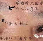 阿婆，你的眼睛肿么了？”5分钟了解眼部淋巴瘤