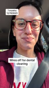 First time seeing the wires off! #fyp #braces #jawsurgery