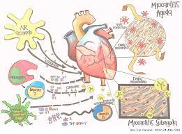La miocarditis es la inflamación del músculo cardiaco. Miocarditis En Pediatria Revista Colombiana De Cardiologia