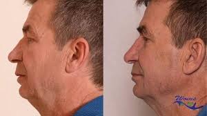 As we age, our skin loses elasticity. How To Get Rid Of Sagging Jowls Woms