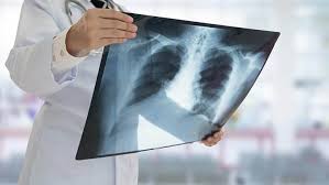 Η πνευμονική εμβολή (pulmonary embolism ή pe) είναι η ξαφνική απόφραξη μικρής ή μεγάλης περίπου 17.000 έλληνες κάθε χρόνο παρουσιάζουν vte (δηλαδή πνευμονική εμβολή από εν τω. Pneymonikh Embolh Symptwmata Kai 8erapeia Doctoranytime Blog
