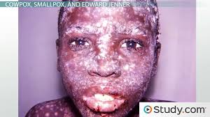 Health authorities in the west african. Diseases Of The Poxviridae Virus Family Smallpox Cowpox Monkeypox Video Lesson Transcript Study Com
