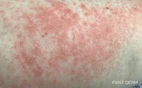 Image result for contact dermatitis