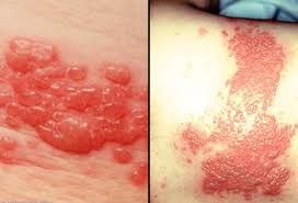 Samples retrieved from a patient who died on 2 august in southern gueckedou prefecture have discovered a deadly virus. Shingles Picture Image On Medicinenet Com
