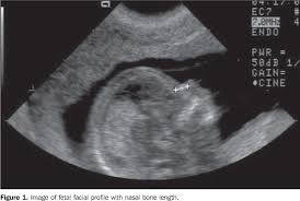 Measurement Of Fetal Nasal Bone Length In The Period Between