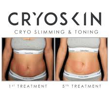 These paddles suction your fat and then cool it. Cryoskin 2 0 Cryotherapy Wellness Center