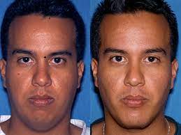 Podés comentar y pedir asesoramiento. Bichectomia Antes Y Despues Ayuda Solucion 2021