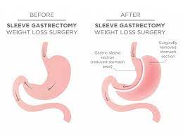 The sleeve gastrectomy (gastric sleeve) decreases hunger and meal size by reducing the size of the stomach. Gastric Sleeve Cost Fees Weight Loss Bariatric Surgery Perth