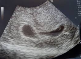 It is also not uncommon for some women to spot during normal periods. 6 Weeks Pregnant With Twins Twiniversity