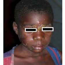 PDF) Clinical outcome of skin yaws lesions after treatment with  benzathinebenzylpenicillin in a pygmy population in Lobaye, Central African  Republic