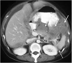 The scan lets them:learn the cancer's stage. Ct In Ovarian Cancer Staging How To Review And Report With Emphasis On Abdominal And Pelvic Disease For Surgical Planning Cancer Imaging Full Text