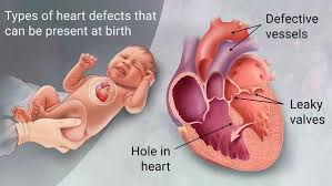 Congenital Heart Disease Heart Defect Congenital Heart Defect Awareness Congenital Heart Defect