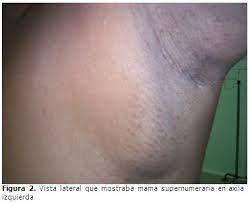 Mama Supernumeraria Axilar Presentacion De Un Caso Y Revision De La Literatura