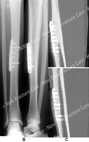 Image result for Tibia Stress Fracture