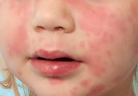 Hives can result from a medical condition or exposure to substances or extreme temperatures. 5 Rashes Your Child May Bring Home From Preschool Health Essentials From Cleveland Clinic