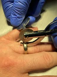 Image result for Ring Removal