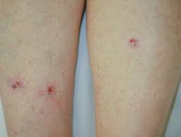 The difference between a mole and skin cancer generally comes down to size, shape, color, and elevation. Basal Cell Carcinoma Affecting Arms And Legs Images Dermnet Nz