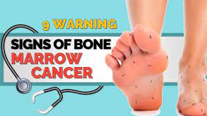 Doctors use these procedures to diagnose and monitor blood and marrow diseases, including some cancers, as well as fevers of unknown origin. 9 Warning Signs Of Bone Marrow Cancer Youtube