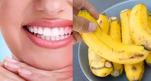~ first, doktor gigi akan amik skala tahap kekuningan gigi kau. Putihkan Gigi Kekuningan Dengan Kulit Pisang Seriuslah Berkesan Remaja