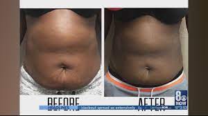 Lose Weight Without Diet & Exercise - Youtube