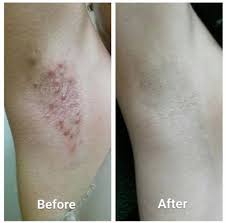 I have one or two spots that look like a pimple or ingrown hair what do i do? pimple or ingrown: This Magical Product Will End Ingrown Hairs And Razor Bumps For Good