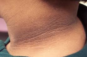 Pigmentation On Nape Of Neck Dark Skin Around Neck Dark Neck Remedies Skin Tags Home Remedies