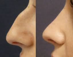 Rhinoplastik, allgemein als nasenkorrektur bezeichnet, ist ein chirurgischer eingriff, bei dem die form ihrer nase durch modifikation des knochens oder knorpels verändert wird. Nasenkorrektur Nasen Op Prag Tschechien Ausland Perfect Clinic