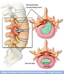 It's very common but usually goes away within 4 weeks. Lower Back Pain Disc Versus Muscle And The Athlete Bucks Sports Chiropractic Dr Derek Gearhart