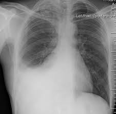 Mesothelioma is an aggressive cancer that affects the lungs, heart, abdomen or testiciles. Does Pleural Effusion Impact Mesothelioma Outlook Mesothelioma Net