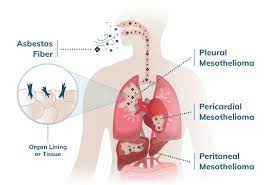 The good news is many cases of lung cancer are believed to be preventable, as an estimated 90% of lung cancer cases are caused by active smoki. Malignant Mesothelioma Cancer Stages Prognosis Treatment