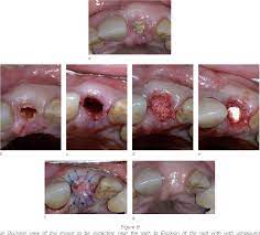 Pdf Healing Processes Following Tooth Extraction In Orthodontic Cases Semantic Scholar