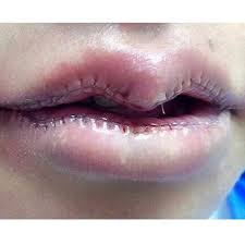 Oct 19, 2019 · the deeper layer brings the deep part of the cut together. Stitches Under Lip Novocom Top