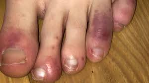 Here is an overview of the reactions and here is an overview of the reactions and side effects you can expect. Coronavirus From Covid Toes To Covid Tongues New Virus Symptoms Of Continue To Emerge Ctv News